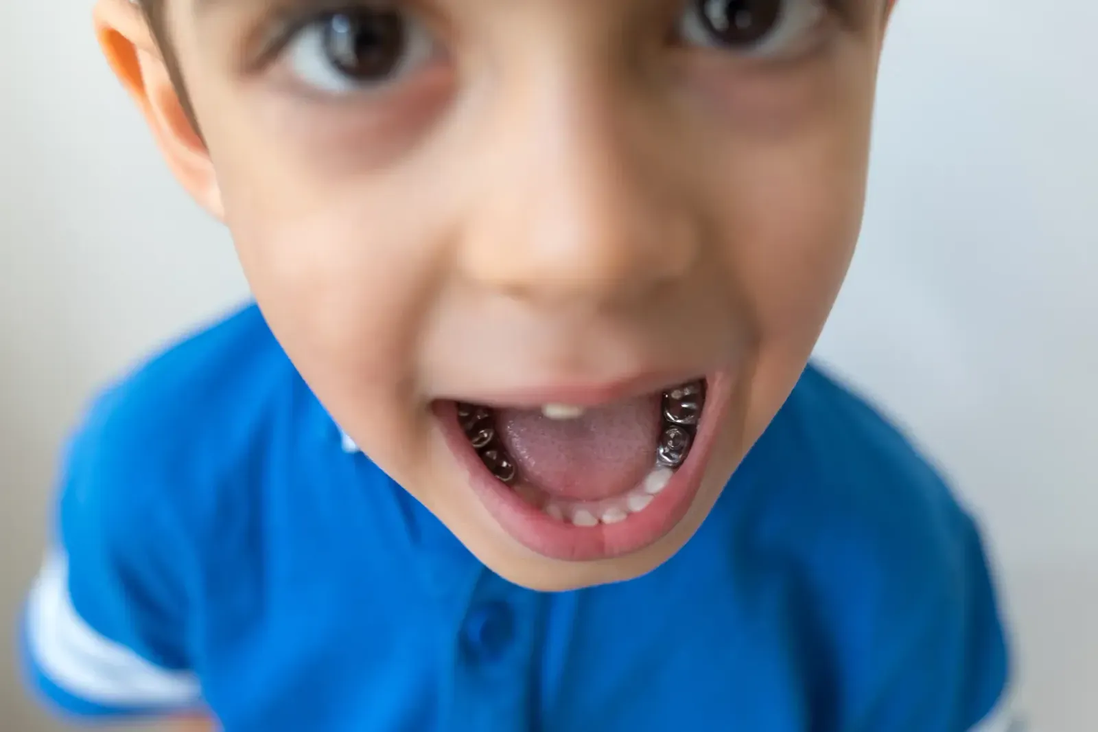 Baby Teeth Crowns: Why They Matter More Than You Think
