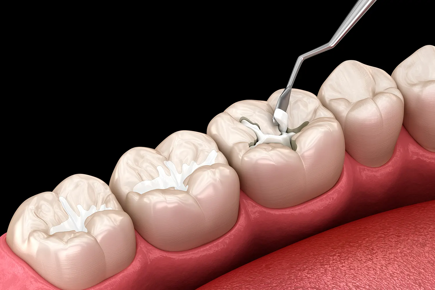 The Long-Term Benefits and Cost-Effectiveness of Dental Sealants for Children