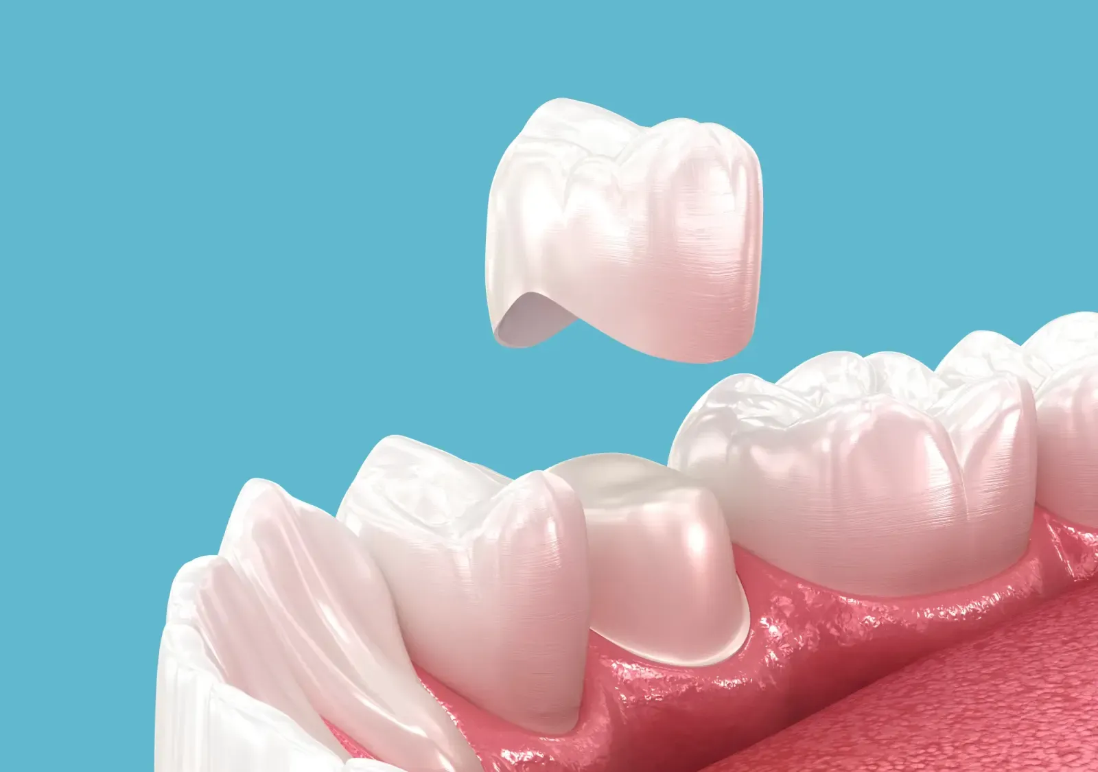 How Long Do Pediatric Crowns Last? And How to Care for Them at Home