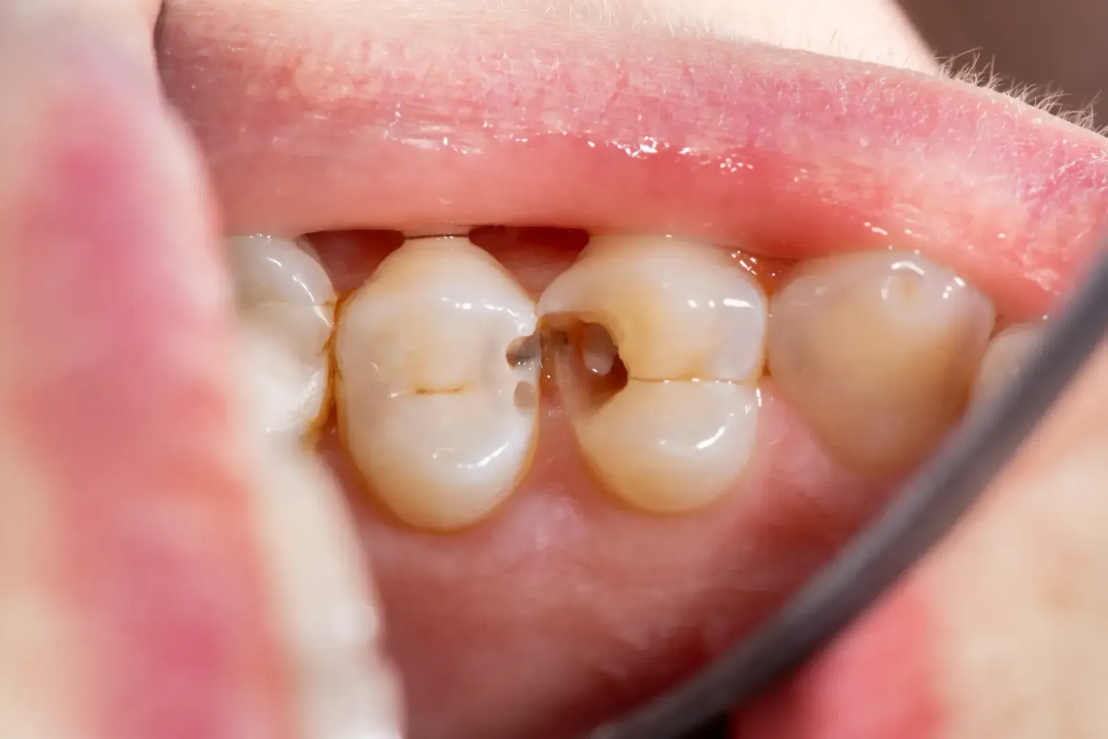 Fluoride Varnish vs. Topical Fluoride: Which Cavity Prevention is Right
