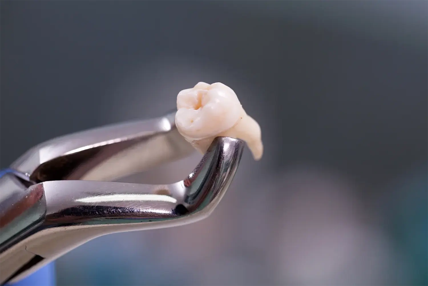 pediatric tooth extraction in Fremont