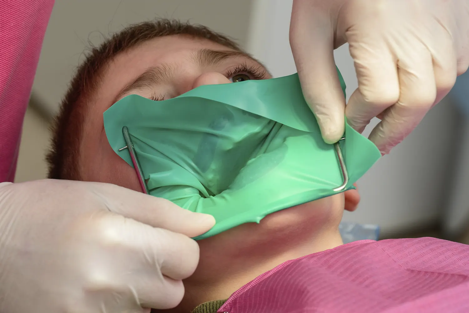 Pulpotomy vs. Baby Root Canal: Saving Primary Teeth at Mission Peak Pediatric Dentistry