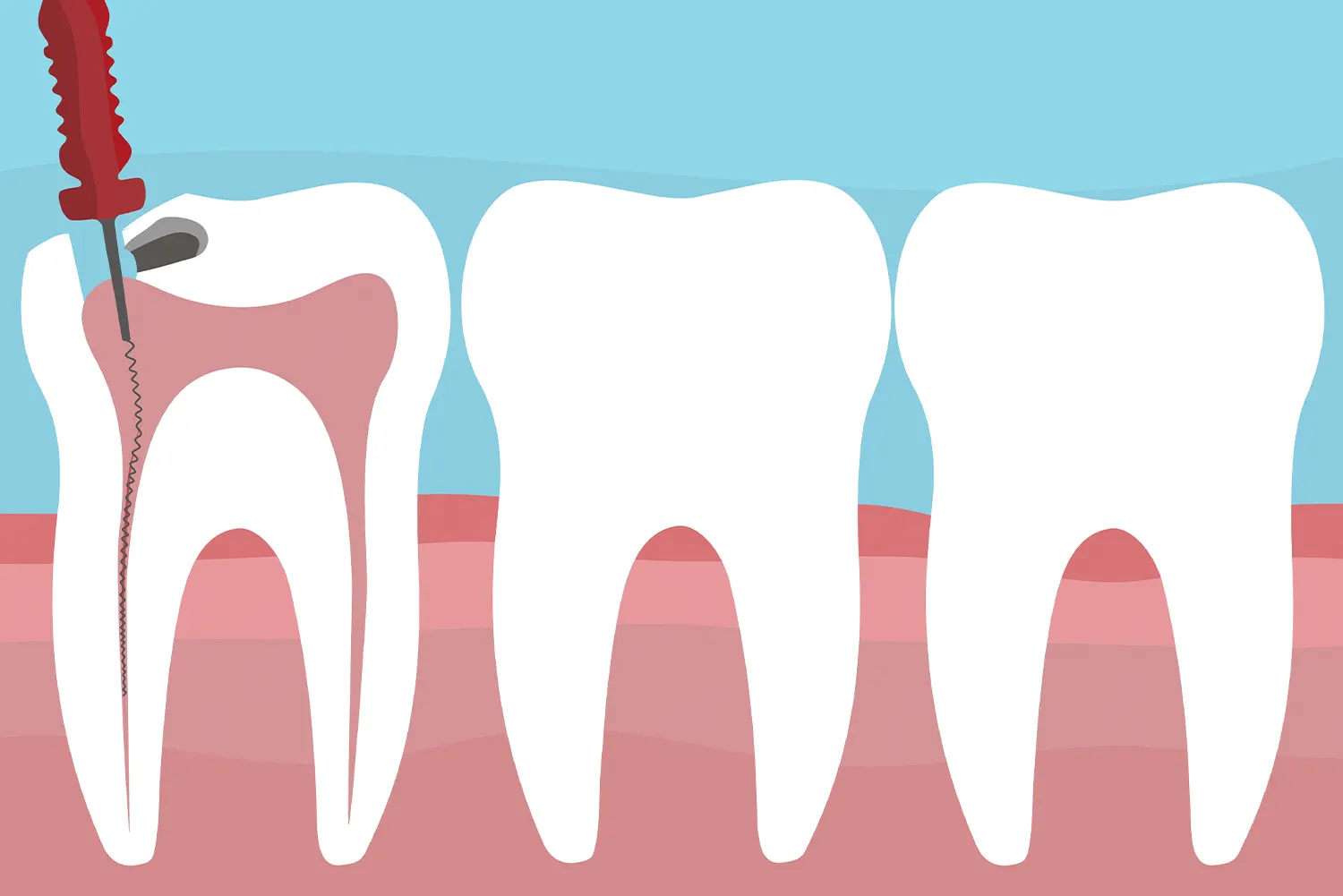 Pulpotomy vs. Extraction: Weighing the Pros and Cons for Your Child's Dental Health