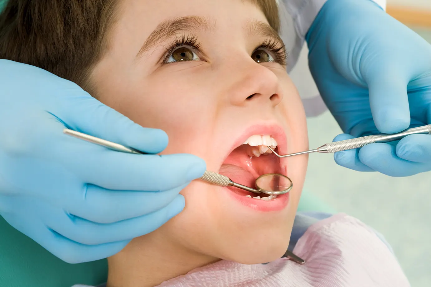Do Baby Teeth Need Fillings